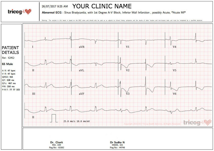 Turning the Tide on Heart Attacks Using Cloud Computing